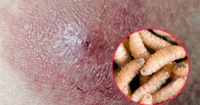 Confirma Salud 5 casos de miasis de gusano barrenador en Guerrero